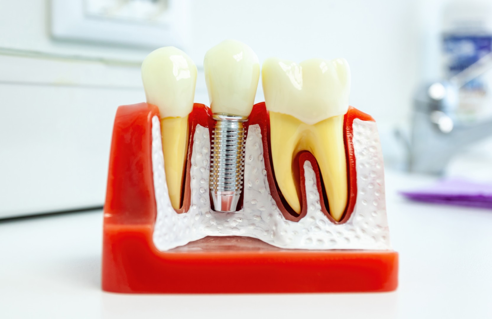 Qué son los implantes dentales