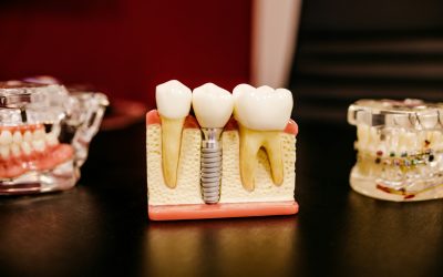 Qué son los implantes dentales y sus ventajas